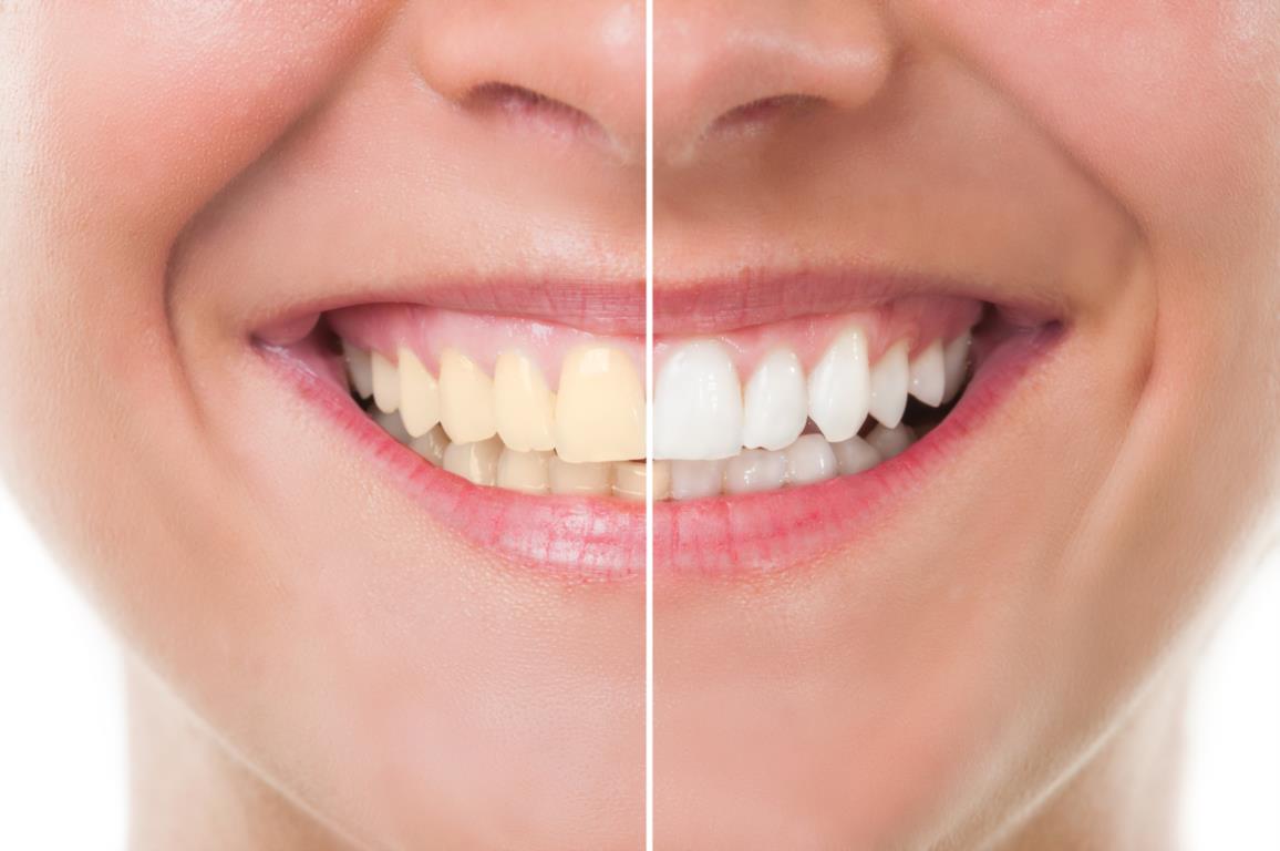 Teeth Whitening Teeth Whitening